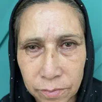 جراحی پلک با متد چشم گربه ایی با بخیه لیزری|خدمات آرایشگری و زیبایی|تهران, قیطریه|دیوار