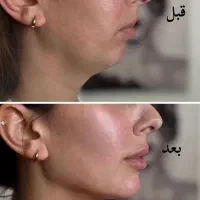 فیلر بادی ،تزریق ژل و بوتاکس با بهترین متریال قیمت|خدمات آرایشگری و زیبایی|دزفول, |دیوار