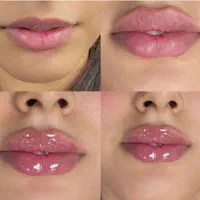 بوتاکس ،فیلر و ژل لب ، لیفت نخ ، انزیم ،مزوتراپی|خدمات آرایشگری و زیبایی|مشهد, جانباز|دیوار