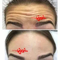 تزریق فیلر ژل و بوتاکس در کلینیک|خدمات آرایشگری و زیبایی|بندرعباس, |دیوار