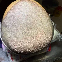 جشنواره ویژه کاشت ابرو و مو یک روزه فقط نه میلیون