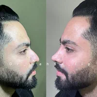 تزریق ژل بوتاکس زاویه فک گونه شقیقه فیلرلب روسی|خدمات آرایشگری و زیبایی|تهران, پونک|دیوار