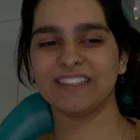 کامبوزیت زیبایی کامپوزیت دندان ضمانت ۵ ساله|خدمات آرایشگری و زیبایی|نهاوند, |دیوار