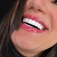 کامپوزیت اقساطی لمینیت ایمپلنت دندانپرشکی|خدمات زیبایی و سلامت|تهران, زعفرانیه|دیوار