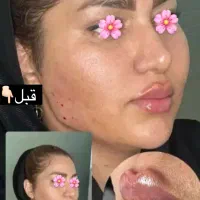 تخفیفات ویژه پاییزه ژل وبوتاکس(خانمهاواقایان)