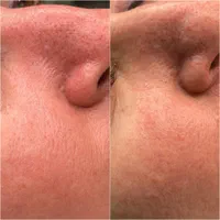 تکنیک ریموو تاتوهای قدیمی صورت و خاویارتراپی|خدمات آرایشگری و زیبایی|نیشابور, باغرود|دیوار