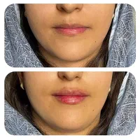 تزریق ژل و بوتاکس|خدمات آرایشگری و زیبایی|امیدیه, |دیوار