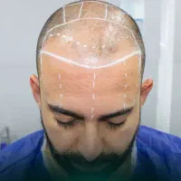 کاشت مو فقط در یک روز با ضمانت تراکم|خدمات آرایشگری و زیبایی|اصفهان, کشاورزی|دیوار