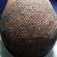 کاشت مو .ابرو .ریش در بیرجند