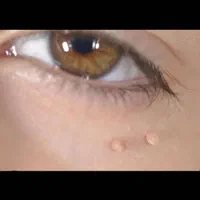 بهبود کامل زگیل تناسلی تضمینی|خدمات آرایشگری و زیبایی|گنبد کاووس, |دیوار