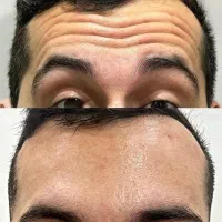 جشنواره بوتاکس ، مزوتراپی ، فیلر و کربوکسی