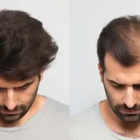 پروتزمو/ تعویض چسب/تخفیف ویژه