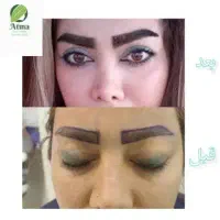 تجربه‌ای متفاوت از زیبایی با کاشت ابرو