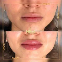 تزریق بوتاکس و فیلر با تخفیف ویژه|خدمات آرایشگری و زیبایی|قزوین, |دیوار