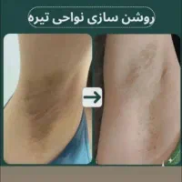 اف تابستانه زیبایی تزریق ژل، بوتاکس، پی ار پی|خدمات آرایشگری و زیبایی|اهواز, کمپلو جنوبی|دیوار