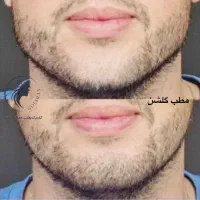 جشنواره ویژه تزریق ژل و بوتاکس و مزو پی آرپی درمطب