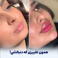 کلینیک زیبایی ژل لب روسی فیلر زاویه مزوبوتاکس لیزر|خدمات آرایشگری و زیبایی|شهریار, شهریار|دیوار