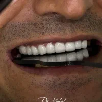 دندانپزشکی/کامپوزیت دیجیتال/ ایمپلنت/عصب کشی|خدمات آرایشگری و زیبایی|مشهد, ده دی|دیوار