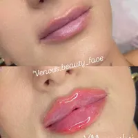 تزریق ژل 390بوتاکس رفع گودی سیاهی زیر چشم لیزر خال