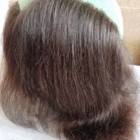 پروتز مو