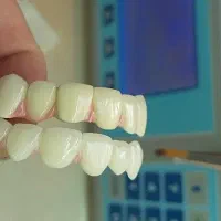 ساخت روکش ثابت کرمانشاه