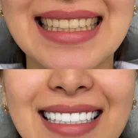 تخفیف ویژه ایمپلنت فوری+متخصص ایمپلنت+اقساط ویژه