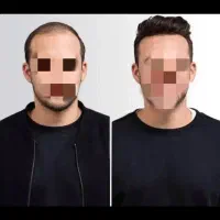 کلاهگیس و پروتز موی طبیعی