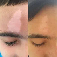 درمان قطعی و تضمینی پیسی و پسوریازیس