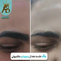 پاک کردن تتو خالکوبی،ریموو تتو ابروـ بدن مایابیوتی|خدمات آرایشگری و زیبایی|یاسوج, |دیوار
