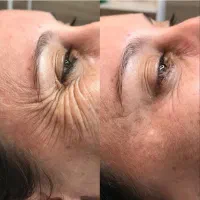 جوانساز پی آر پیprp صورت و ریزش مو و زخم و لک|خدمات آرایشگری و زیبایی|هشتگرد, شهرک ولیعصر (مصلی)|دیوار