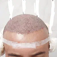 کاشت تخصصی مو و ریش،مزوتراپی،prp(تضمینی)|خدمات آرایشگری و زیبایی|اصفهان, سعادت‌آباد|دیوار