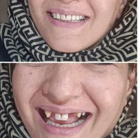 دندان دندانسازی پروتز با چک|خدمات آرایشگری و زیبایی|مشهد, موعود|دیوار