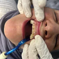 کامپوزیت دندانپزشکی تخفیفه ویژه اقساط چکی|خدمات آرایشگری و زیبایی|تهران, شهرک ولیعصر جنوبی|دیوار