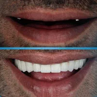 کامپوزیت ایمپلنت ارتودنسی بندرعباس|خدمات آرایشگری و زیبایی|بندرعباس, |دیوار