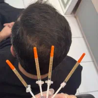 پی آر پی prp جشنواره پوست و مو