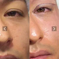 جراحی بلفارو پلاستی نیم بها