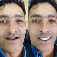 دندانسازی،دندان مصنوعی،جوان پسند،اقساطی با چک|خدمات آرایشگری و زیبایی|مشهد, شاهد (شهرک غرب)|دیوار