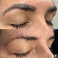 ریموو تاتو صورت و بدن با لیزر کیوسوییچ امریکایی|خدمات آرایشگری و زیبایی|گرگان, |دیوار