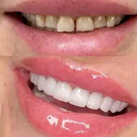 جشنواره کامپوزیت دندان از واحدی 800تومن شروع قیمت|خدمات آرایشگری و زیبایی|صفادشت, |دیوار