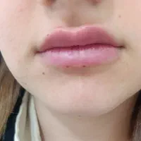 آفر ویژه فیلر -مزو جوانسازی-بوتاکس چشم گربه ای