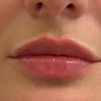 به ۳ نفر مدل جهت تزریقات لب زیر نظر پزشک نیازمندیم