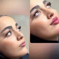 بوتاکس و فیلر پی ار پی مزوتراپی کانتورینگ