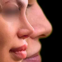 عمل جراحی بینی توسط متخصص زیباییent/ترمیم بینی|خدمات آرایشگری و زیبایی|کرج, چهارصد دستگاه|دیوار