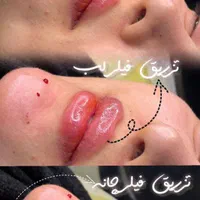 مرکز تخصصی تزریق چربی/فیلرلب و صورت/نخ لیفت/بوتاکس|خدمات آرایشگری و زیبایی|مشهد, سجاد شهر|دیوار
