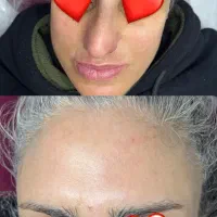 رفع تیرگی نواحی خصوصی