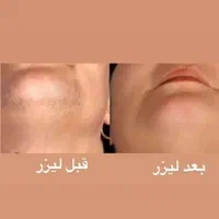 لیزرموهای زائدبادستگاه آلمانی+فیلر+بوتاکس+مزوتراپی