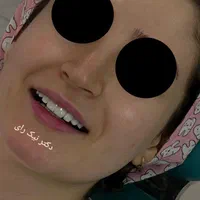 کامپوزیت زیبایی دندان|خدمات آرایشگری و زیبایی|صحنه, |دیوار