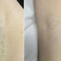 لیزر فقط ‌فقط 690تومان|خدمات آرایشگری و زیبایی|گنبد کاووس, |دیوار