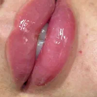 جشنواره تخفیف تزریق تخصصی ژل و بوتاکس|خدمات آرایشگری و زیبایی|شیراز, محراب|دیوار