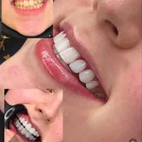 افر ویژه کامپوزیت دندان مواد تضمینی و اصلی